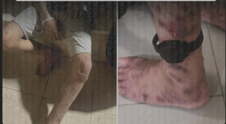 Israeli Occupation Uses Prisoner Transfers to Spread Disease Among Palestinian Detainees